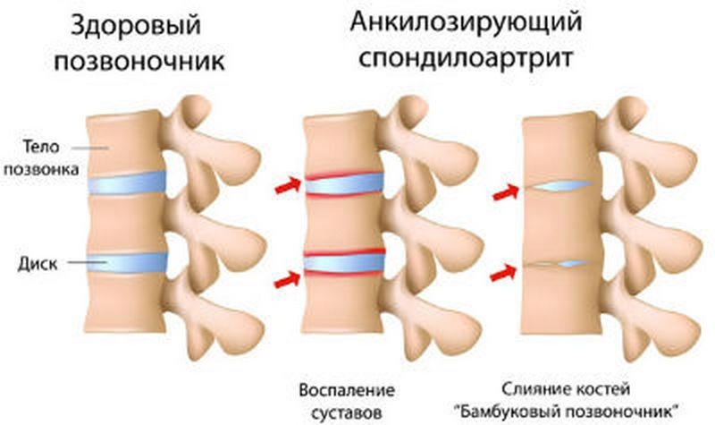 три стадии развития заболевания