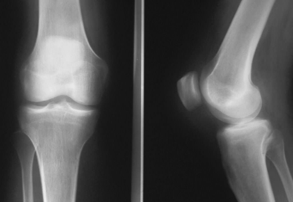 Бурсит коленного сустава на рентгеновском снимке