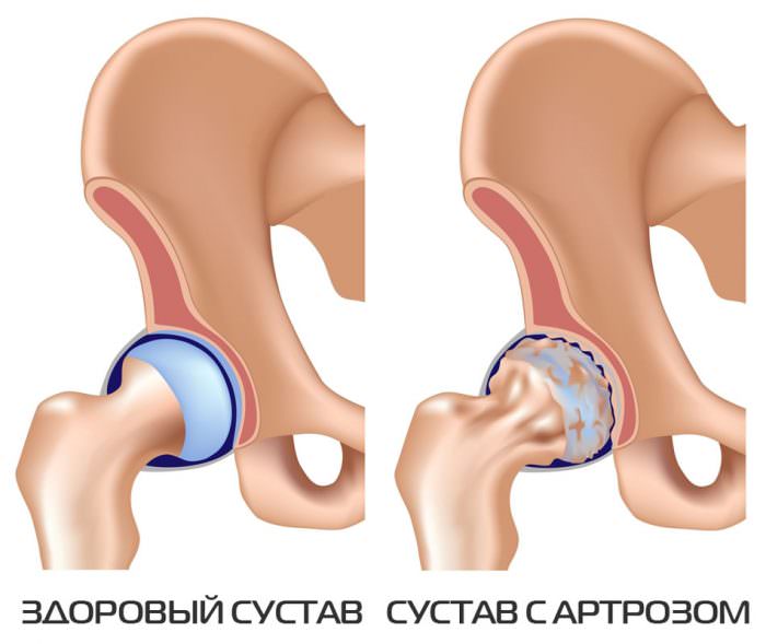 Артроз тазобедренного сустава