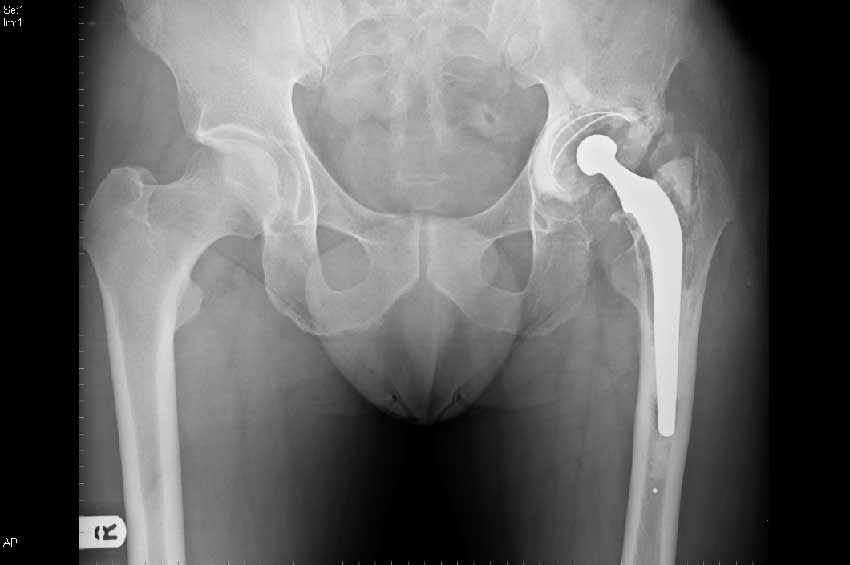 Рентген протеза бедра