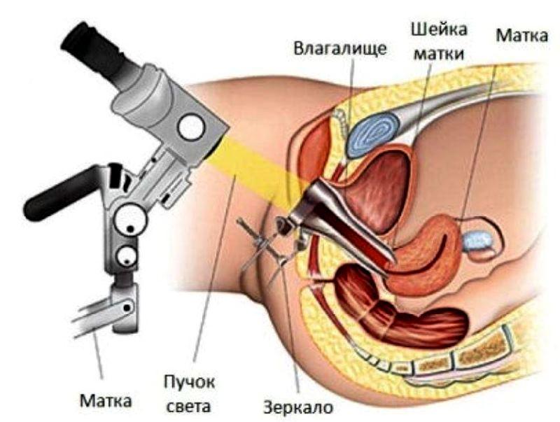 Кольпоскопия шейки матки