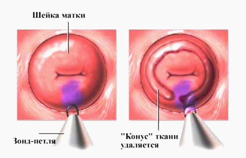 Прижигание током низкой частоты