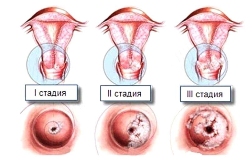 3 стадии дисплазии шейки матки