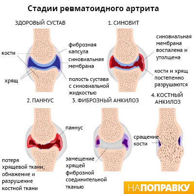 четыре стадии прогрессирования ревматоидного артрита