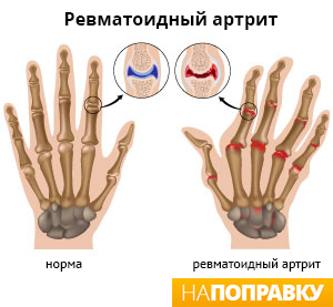 искривление пальцев рук при ревматоидном артрите