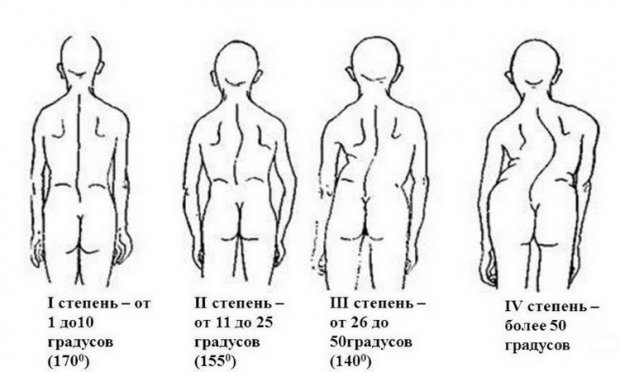 ЛФК при сколиозе 1 степени