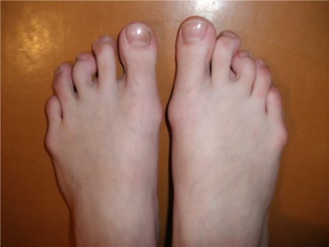 Брахидактилия пальцев ног