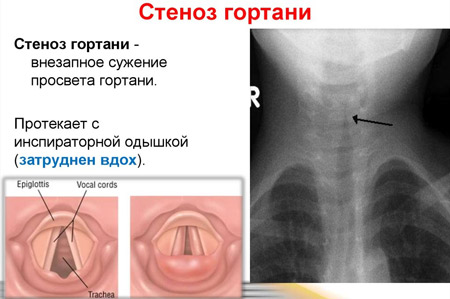 Особенности стеноза