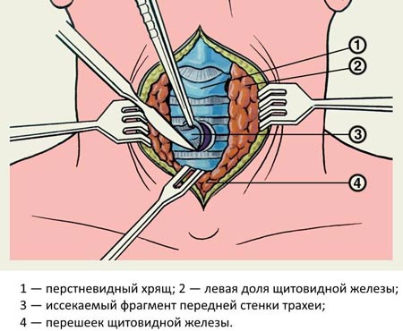 Проведение трахеостомии