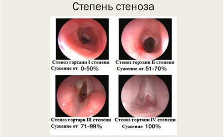 Степени стеноза