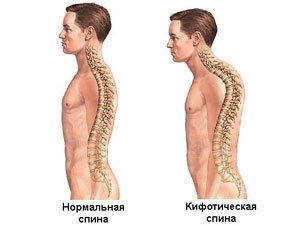 Типы спины: нормальная и кифотическая