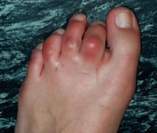 Артроз пальцев ног
