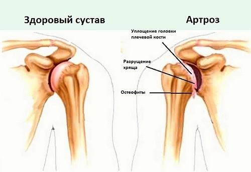 Артроз плечевого сустава