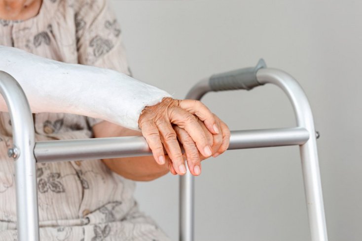 Переломы у пожилых: принципы лечения