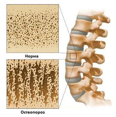 Остеопороз делает позвоночник человека хрупким