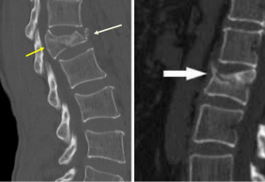 Диагностировать перелом можно с помощью рентгена, компьютерной томографии, МРТ или сканирования