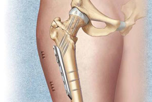 Основная задача титановой пластины - возобновление первоначальной формы кости