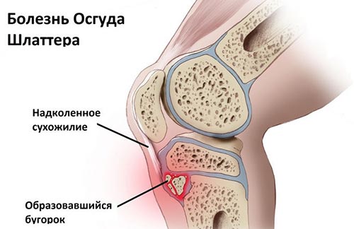 Болезнь Осгуда-Шляттера