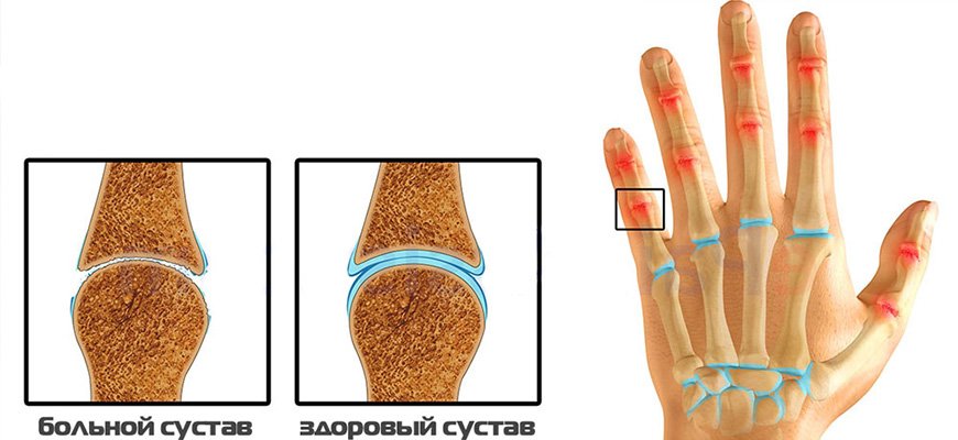 Артроз кистей рук: симптомы и лечение - изображение 2