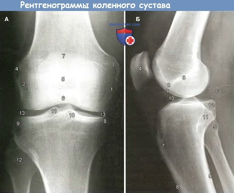 Два мыщелка. Коленный сустав рентген анатомия. Коленный сустав рентген норма. Строение коленного сустава рентген. Рентген коленного сустава в боковой проекции норма.