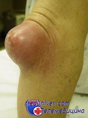 Бурситы коленного сустава. Диагностика и лечение