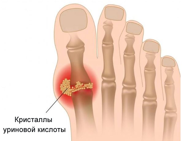 Болезнь чаще всего поражает суставы пальцев ног, кисти, локти и колени. В периоды ремиссии больного не беспокоят проявления подагры, но при погрешностях в питании возможны приступы сильной боли, воспаление, отек и повышение температуры на пораженном участке.  Очень часто подагра сопровождается достаточно сильной болью и другими неприятиями симптомами. Из-за ограниченной подвижности, у больных ухудшается качество жизни и они нуждаются в медикаментозном лечении. Справиться с заболеванием возможно в домашних условиях, если соблюдать все рекомендации врачей.  В первую очередь при подагре пациенту необходима специальная диета. При этом назначенный врачом рацион должен соблюдаться не только во время обострения болезни, но и в период ремиссии. Каждый день необходимо следить за своим меню. Правильное питание при подагре играет важную роль, от него зависит успех всего лечения и гарантия уменьшения случаев обострения патологии.