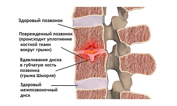 Грыжа Шморля