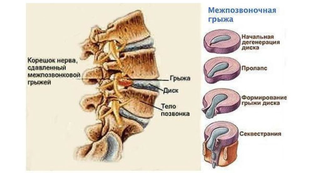 Стадии грыжи