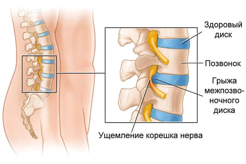 Ущемление нерва при грыже