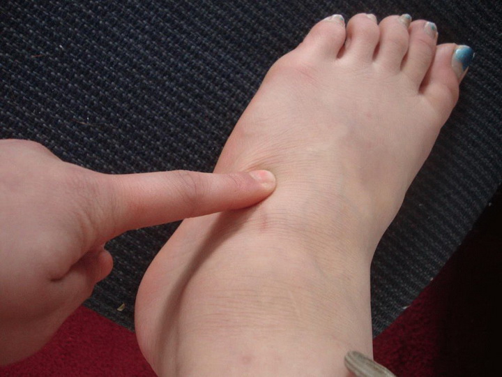 Болит нога в области стопы сверху: что делать, если очень больно наступать и есть припухлость