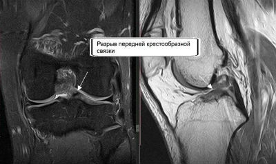 Разрыв передней крестообразной связки на МРТ-снимке