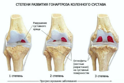 Степени развития гонартроза