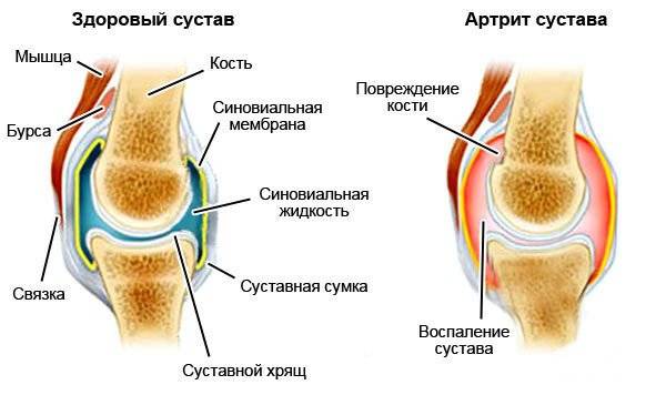 Коленный сустав в норме и при артрите