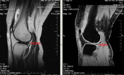 Гонартроз коленного сустава на МРТ