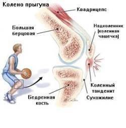 Тендинит коленного сустава в месте прикрепления сухожилия к надколеннику