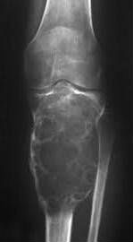 Злокачественное новообразование захватывающее коленный сустав и большеберцовую кость на рентгеновском снимке