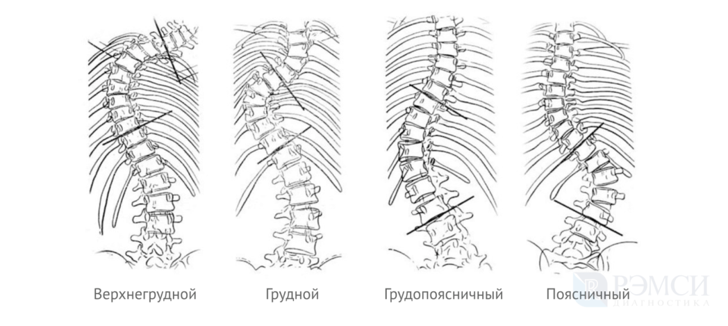 Искривление грудного отдела позвоночника: виды сколиоза