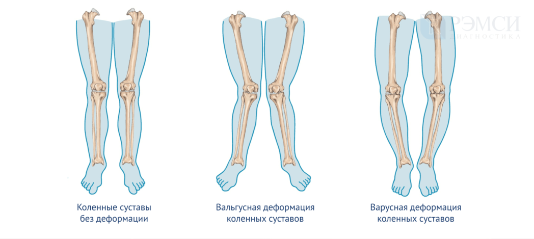 Виды деформации коленного сустава