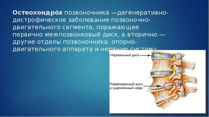 Дегенеративные изменения грудного отдела позвоночника что это. Дистрофически-дегенеративные изменения позвоночника. Остеохондроз позвоночника. Дегенеративно-дистрофические заболевания позвоночника. Остеохондроз двигательных сегментов позвоночника.