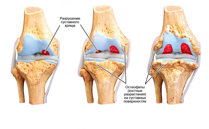Износ хрящевой ткани коленного сустава