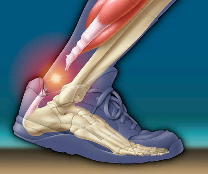 Разрыв ахиллова сухожилия - очень серьезная травма
