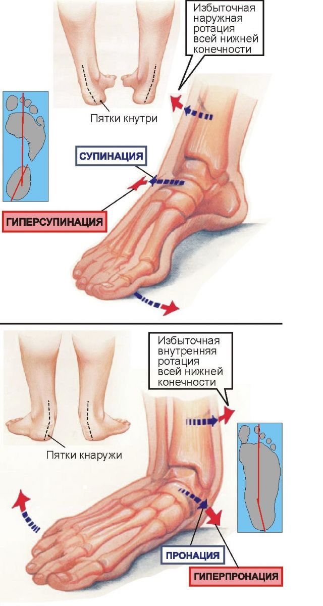 Все, что нужно знать бегуну о гиперпронации