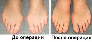 Так выглядят ноги после операции по удалению косточек на больших пальцах ног