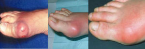 Симптомы подагрического артрита стопы
