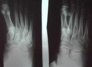 Рентгеновский снимок перелома со смещением