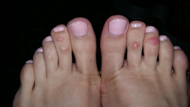 Как лечить шишки на пальцах ног и между пальцев