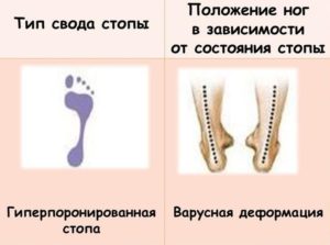 Положение ног при варусной деформации