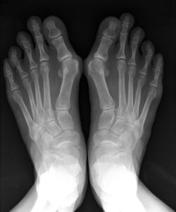 Рентгеновский снимок стоп при бурсите