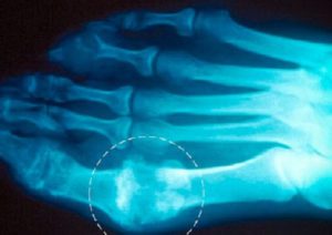 Суставы пальцев ног на рентгене