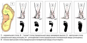 Разновидности вальгусной деформации